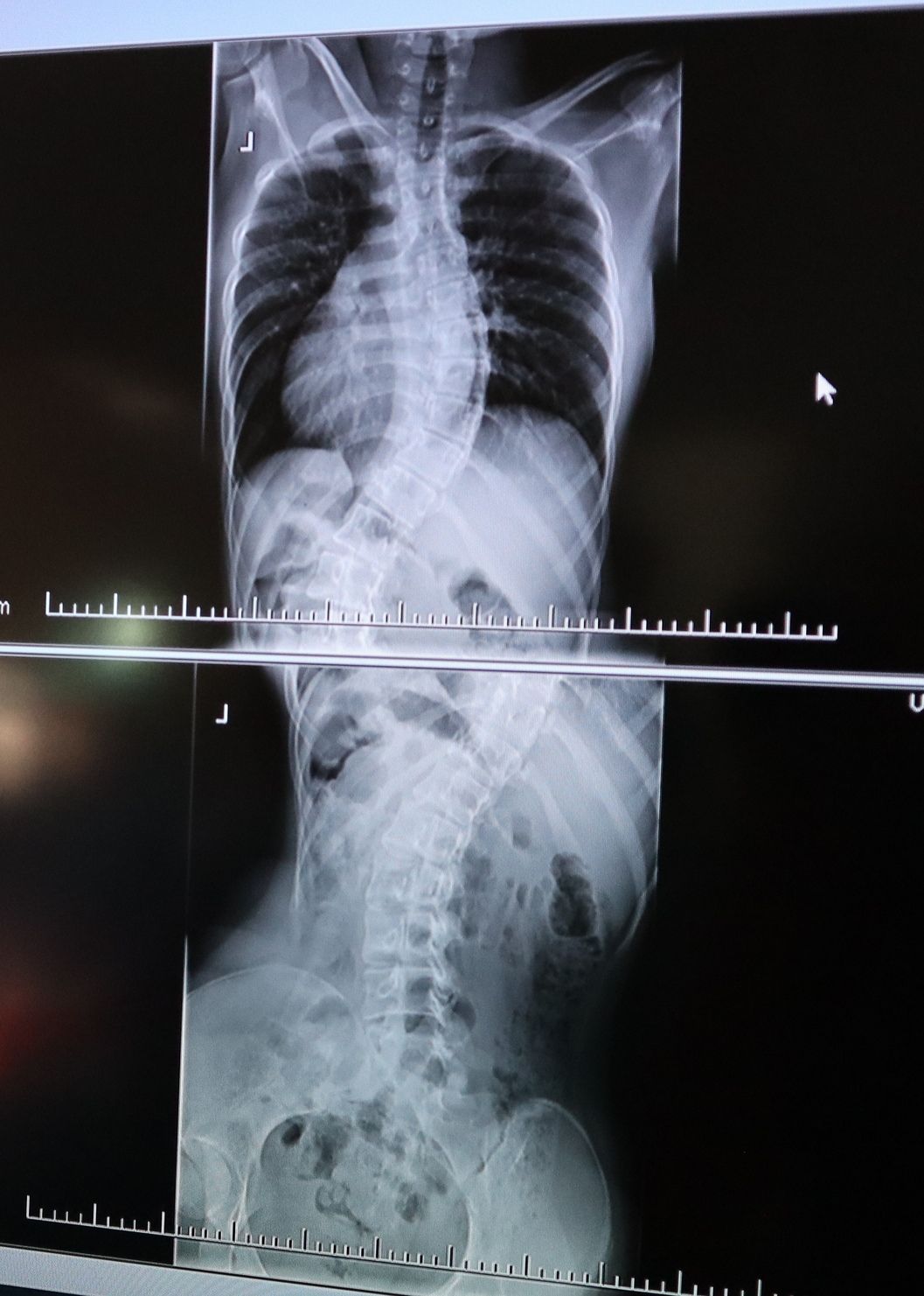 FNsP ZA_Idiopatická skolióza 16-ročnej pacientky pred operáciou.jpg
