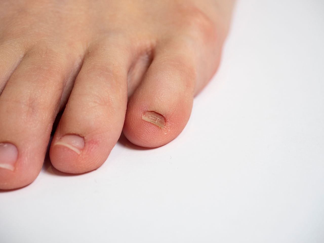 human-foot-white-background-with-nail-problems.jpg
